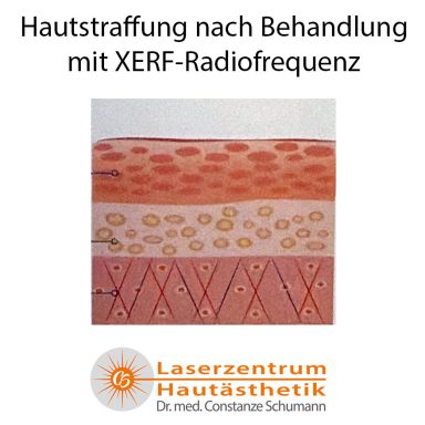 Erfolgte Hautstraffung XERF Methode Straubing