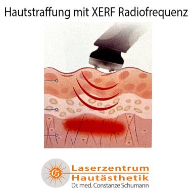 Hautstraffung mit XERF Rediofrequenz Methode